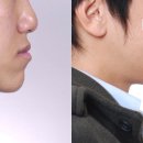 [교정][치아교정][신촌치과][신촌치아교정] 악교정 수술, 주걱턱, 긴 얼굴 이미지