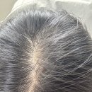 비오케이 | 모발탈락 고민으로 찾은 모발영양제, 비오케이 유산균 체험 후기