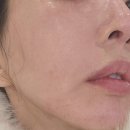 샤넬멍 | 강남역피부과 리쥬엘에서 통증 없는 엑소샤넬 시술 후기 (통증/효과/전후비교)