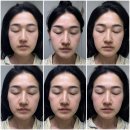 모두비교 | 침샘보톡스 심부볼제거 리터치도 세심한 곳 얼굴 고민 모두 해결한 전후 비교 후기