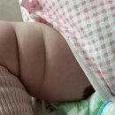 닥터지의원 | 6개월 아기 왕점 선천성 모반 치료 여부 제거 후기