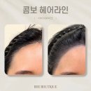 콤보 헤어라인 SMP 두피 문신 반영구 후기 / 자연결 승무원 이마 광주 첨단
