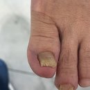 레푸스 | 창원발톱무좀 레푸스 관리 후기