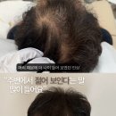 누가의료기검단지점 | 검단 두피문신, 왜 만족도 차이가 크게 날까요?