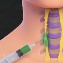 속편한내과마취통증의학과의원 | 교감신경 항진/과활성화 치로는 i-PRF, 마취통증의학과에서 자율신청치료를 해야하는 이유 [성산신경절...