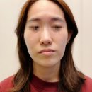 안면비대칭 수술 병원 가격 총정리. 7군데 알아봄