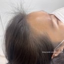 1415 | 역삼 삼성 헤어라인 문신 받고 1년 뒤 후회한다?!