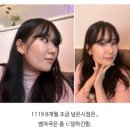 보조개 절개 수술 (1년 ~ 2년차 후기)