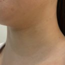 유비에이성형외과의원 | 다비다성형외과 바이리즌 목주름 시술 후기