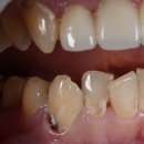 아이콘(icon)치과기공소 | [앞니치료] 충치치료 + 미용치료