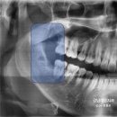 서린치과의원 | 앞니 벌어짐, 티 안 나는 투명교정으로 간단히 공간 닫기 / 매복 사랑니 발치부터 투명교정 후기