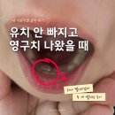 송정봄소아치과의원 | 7살 이중치열 발치 후기 유치 안 빠지고 영구치 나왔을 때