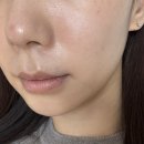 새서울헤론의원 | [홍대] 베러미의원 | 엑소좀·포덴자 내돈내산 후기 (비포에프터)