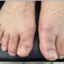 시흥 장곡동 발톱무좀 전문샵 방문 후기 뷰티업라이프 뷰티제작소 시흥장현점