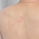 킬러바디 | 등드름없애는법 낫포유 클리어 바디미스트&amp;바디워시 일주일 후기