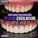 강남 무삭제 라미네이트 내돈내산｜BTS·아이유·뉴진스 다니는 치과에서 받은 솔직후기
