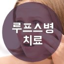 루프스병 치료 어디서부터 시작해야 할까 이미지