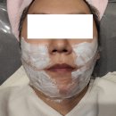 선릉역 약국 | 강남 선릉역 리프팅 로사의원 이중턱 복부지방 고민끝 소프웨이브&amp;X주사 시술후기