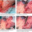 omentalization 이미지
