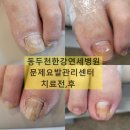 연세한강병원 | [경기도 동두천｜동두천한강연세병원] 입원환자 발톱무좀·내성발톱 치료 사례 후기