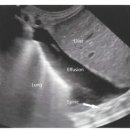 흉막 삼출(Pleural effusion) 이미지