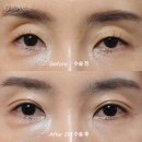 우일종합환경 | 눈꺼풀 패임 문제 눈 위 지방이식 해결 될까?