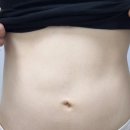 칼로핏 - 제천시 청풍호로 49 | 종로 피부과 명동 지방분해주사 칼로핏 내돈내산 후기