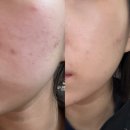 평일빌딩 | 안양 범계 여드름 관리 추천 가로세로한의원 안양평촌점 _ 압출 4회차 비포 애프터 솔직후기