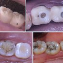동은치과기공소 | 춘천임플란트치과, 5년 내에 재수술 한 이유? [가격, 비용] - 의사의 충고