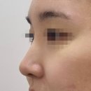유진피부과의원 | [부산서면 코필러/코실] 수술없이 세련된 코 만들기, 더올림의원 찐후기