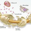 만성염증성 탈수초성 다발신경병증(CIDP) 증상의 조절 및 치유가능성과 헤파짐+지놀짐 요법 이미지