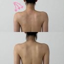 (주)에이오에이코리아 | 압구정액와관리 웰스파 - 솔직후기/부유방, 승모근 부수고 옴