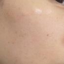 사평대로57길 109 | [신논현/서초/강남 피부관리] 꼼꼼한 좁쌀여드름 관리 ‘아란에스테틱’