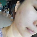 미라네집 | 대구동성로피부과 팔자주름 미라콜 콜라겐주사 내돈내산후기