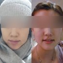 [코어킴스킨] 하이드로 울트라 리프팅 후기