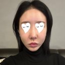 공감성형외과의원 | 강남역 성형외과 가성비 유명한 온다리프팅 받은 후기(통증,가격,효과)