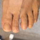 더웰피부과의원 | 두꺼워진 발톱 때문에 고민, 대전발톱무좀 관리 받아본 후기 공유해요