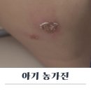 다해어린이집 | 유아 아기 농가진 어린이집 등원 치료 후기