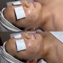 선화에스테틱 | 광주 남구 오월에스테틱, 문제성 피부 에어플라즈마 관리 후기