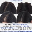 대구헤어라인문신 고민하다가 디에이스칼프 다녀온 후기