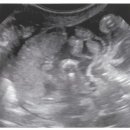 비장(spleen) 이미지
