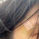 하당약국 | 팩트 성형외과 왕점 돌출점 제거 후기 (1) 2주 경과