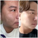 K메디칼 | [다니에르 리뷰] 청담피부과 텐써마 리프팅 리뷰