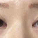 예스안과의원 네이버블로그