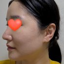 피부나라 - 노원구 | 청담동피부과 줄기세포 피부주사 내돈내산 찐 후기, 시술 전후 느낀 점,