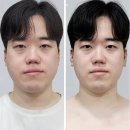 뷰티이어테라피 이침요법 남성 시술 후기 - 혜리 유투브 뷰티꿀템 이침 미뷰에스테틱 후기 공개