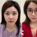 안면거상 잘하는곳? 상담 때 꼭 &#39;ㅂㄹ&#39;를 확인하세요
