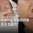 필 | 아쿠아필 내돈내산 후기 | 여름철 모공 각질 피지 효과 (+포텐자 쥬베룩 시술 후 관리)