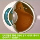 안과- 눈 망막에 구멍이 나면? -비문증 이미지