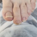 부평레푸스 | 부평 발관리, 발톱무좀 관리 후기 레푸스부평CGV점